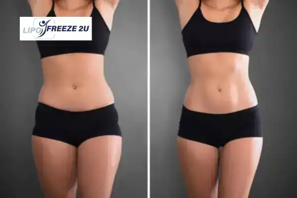 How Can LIPO FREEZE 2U Support Your Post-Pregnancy Body Recovery Kew?