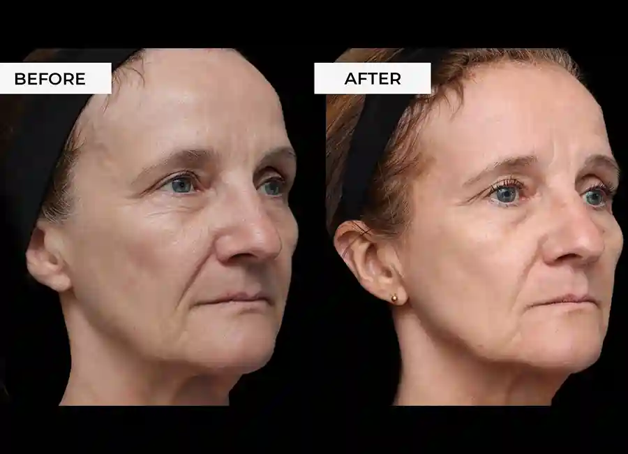 How Many RF Microneedling Sessions Will You Need to See a Difference Kew?