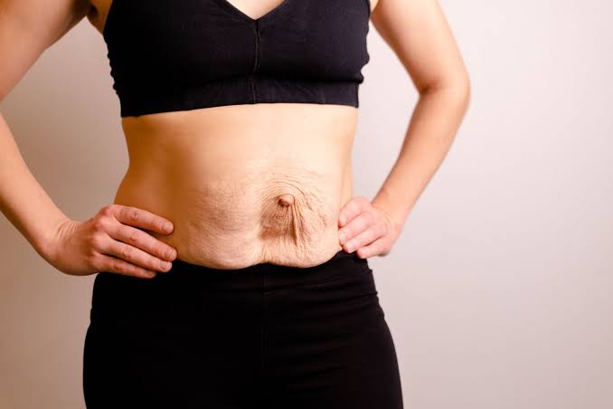Is Surgery Really the Only Way to Repair Diastasis Recti Kew?