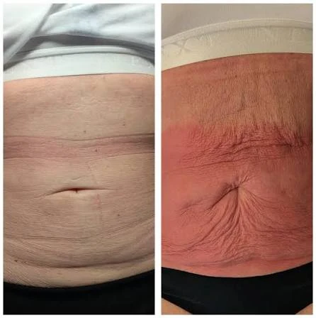 How Does RF Microneedling Improve Crepey, Thin and Uneven Skin Texture Kew?