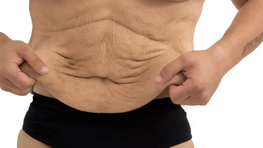 RF Microneedling for Loose Skin: How Can It Help Tighten and Reshape the Skin Kew?